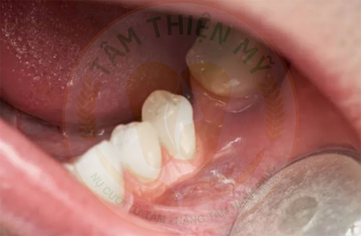 Để mất răng số 7 hàm dưới lâu hậu quả khôn lường 4 Mất răng số 7 hàm dưới