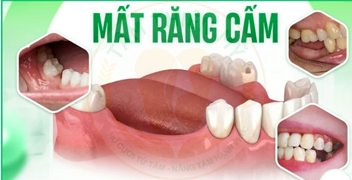 mất răng cấm