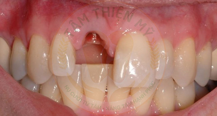 Cấy ghép Implant - phục hình răng cửa bị mất tiên tiến nhất 2 mất răng cửa