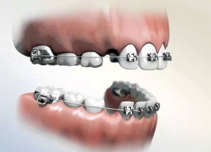 mất răng số 4 có niềng được không