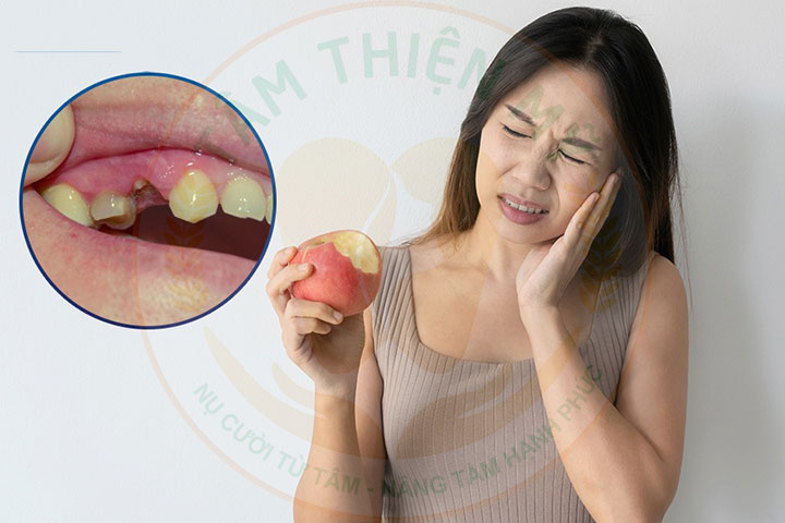 Mất răng số 4 nguy hiểm không