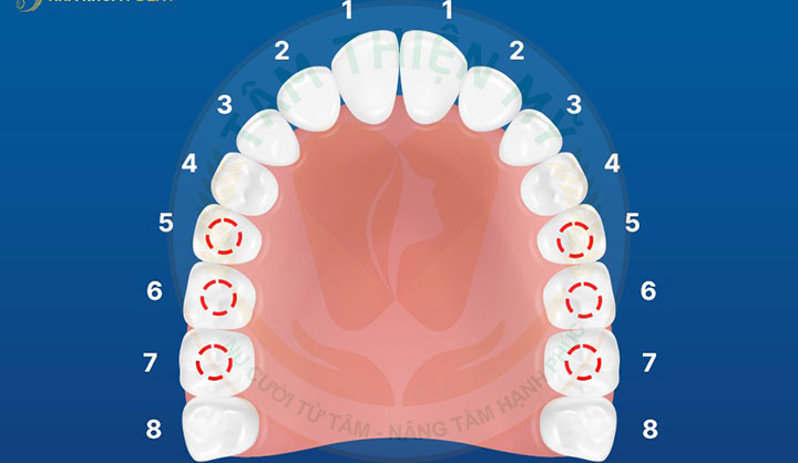 Mất răng 5 bị tiêu xương hàm có cắm được Implant không? 2 vị trí răng số 5