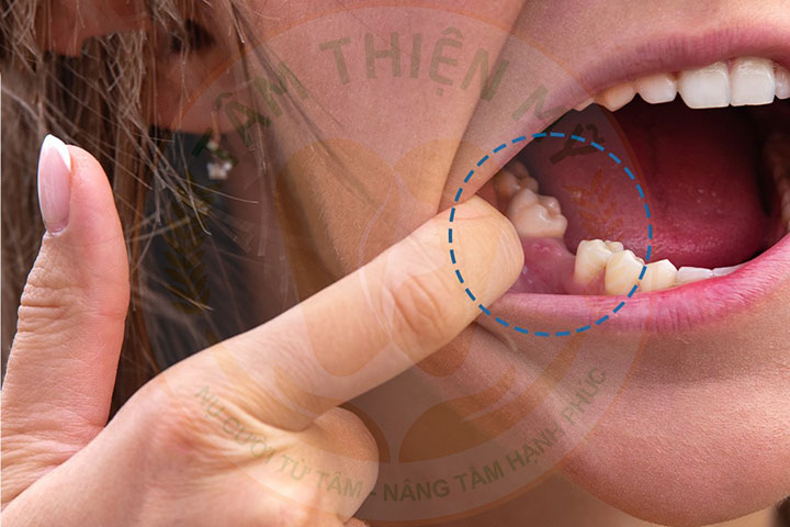 Mất răng 5 bị tiêu xương hàm có cắm được Implant không? 3 Mất răng 5 bị tiêu xương hàm