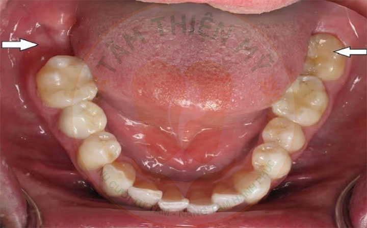 Để mất răng số 7 hàm dưới lâu hậu quả khôn lường 3 Mất răng số 7 hàm dưới