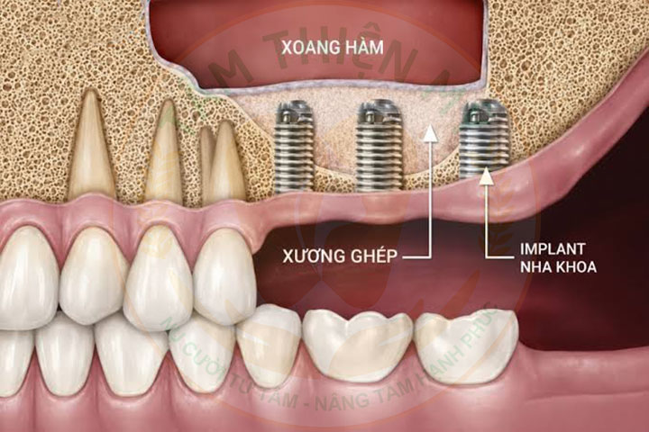 Viêm xoang có trồng Implant được không
