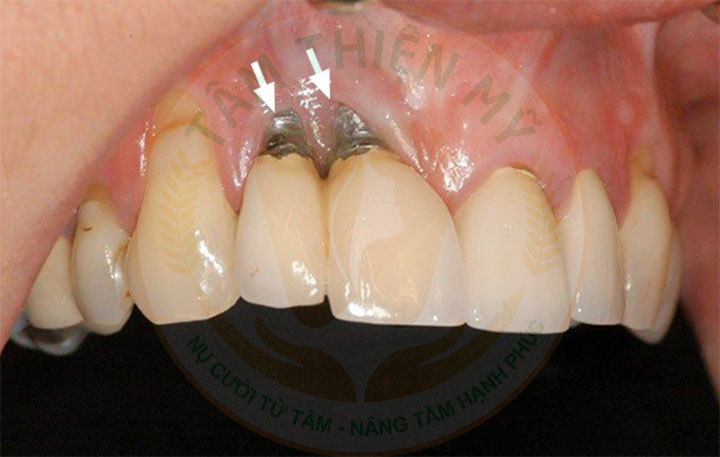 rủi ro khi trồng răng Implant cho người bị viêm nha chu