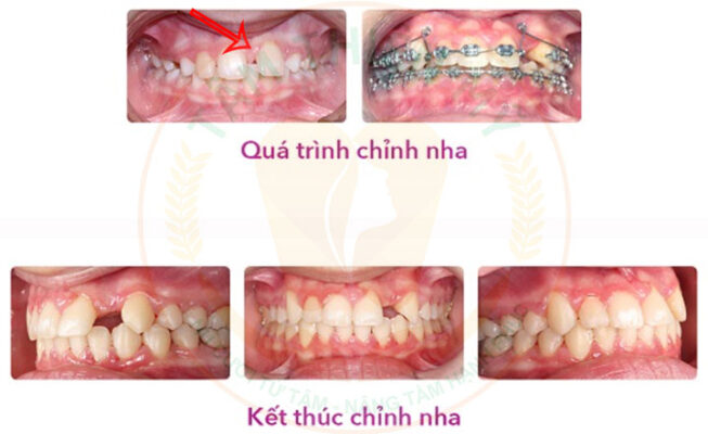 Dấu hiệu trẻ bị thiếu răng bẩm sinh là gì? Nguyên nhân và cách xử 6 niềng răng cho trẻ thiếu răng bẩm sinh