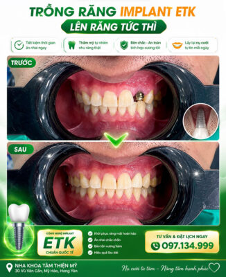 phục hình răng cửa bị mất bằng cấy Implant