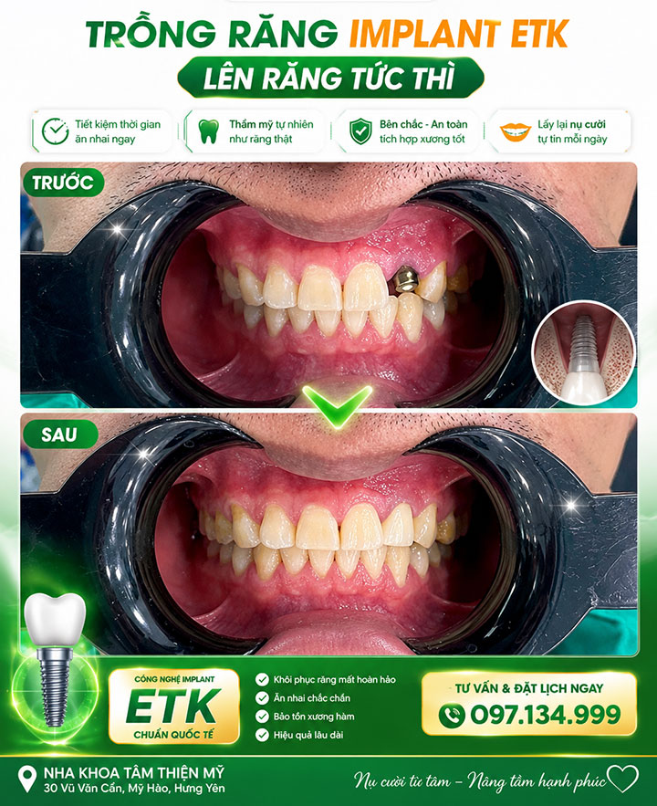 Cấy ghép Implant - phục hình răng cửa bị mất tiên tiến nhất 7 phục hình răng cửa bị mất bằng cấy Implant