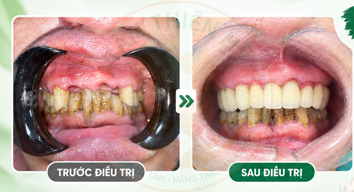 Cấy ghép Implant - phục hình răng cửa bị mất tiên tiến nhất 4 phục hình răng cửa bị mất