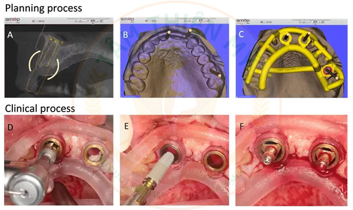 Máng hướng dẫn phẫu thuật Implant