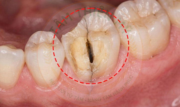 nguyên nhân răng bị nứt gãy chân