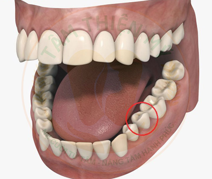 Nguyên nhân và hậu quả khi mất răng số 5- Phục hình răng 5 hiệu 2 Răng 5 là răng nào