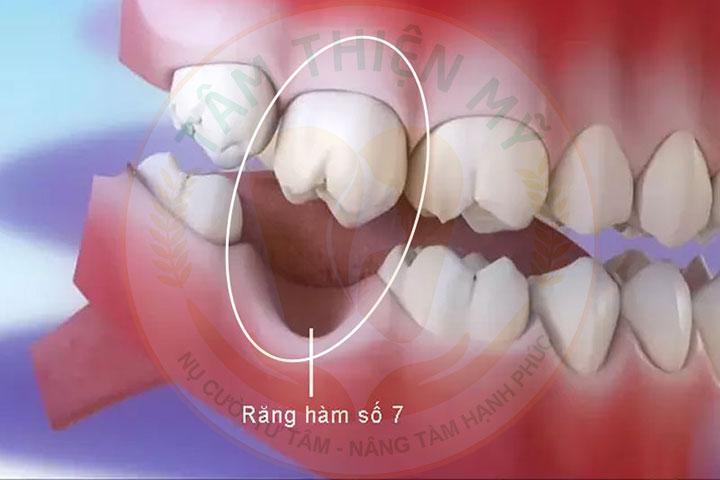 Để mất răng số 7 hàm dưới lâu hậu quả khôn lường 2 Mất răng số 7 hàm dưới