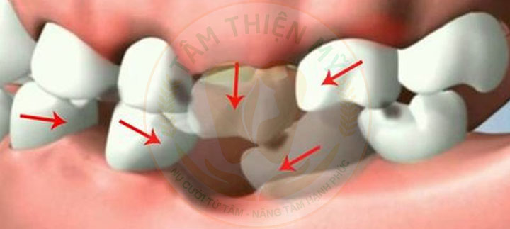 Mất răng 5 bị tiêu xương hàm có cắm được Implant không? 5 răng xô lệch