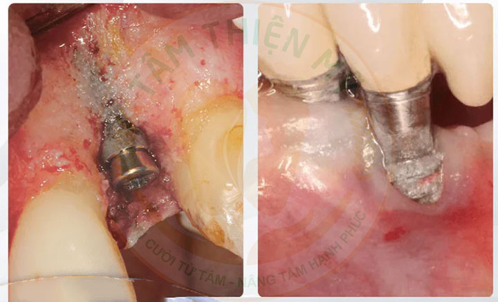rủi ro cấy implant