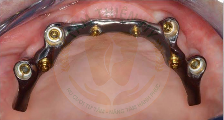 Toàn hàm vững chắc hơn nhờ thanh bar phục hình Implant 5 thanh Bar phục hình Implant
