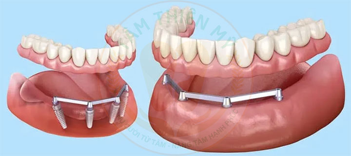 Toàn hàm vững chắc hơn nhờ thanh bar phục hình Implant 3 thanh Bar phục hình Implant