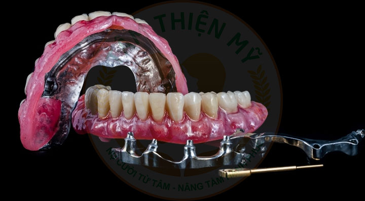 Toàn hàm vững chắc hơn nhờ thanh bar phục hình Implant 2 thanh Bar phục hình Implant