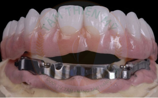 thanh Bar phục hình Implant