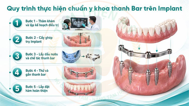 Toàn hàm vững chắc hơn nhờ thanh bar phục hình Implant 7 Quy trình thực hiện chuẩn y khoa thanh Bar phục hình Implant