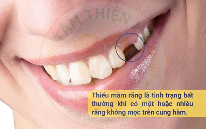 Mầm răng vĩnh viễn là gì? Không có mầm răng vĩnh viễn phải làm sao? 4 không có mầm răng vĩnh viễn