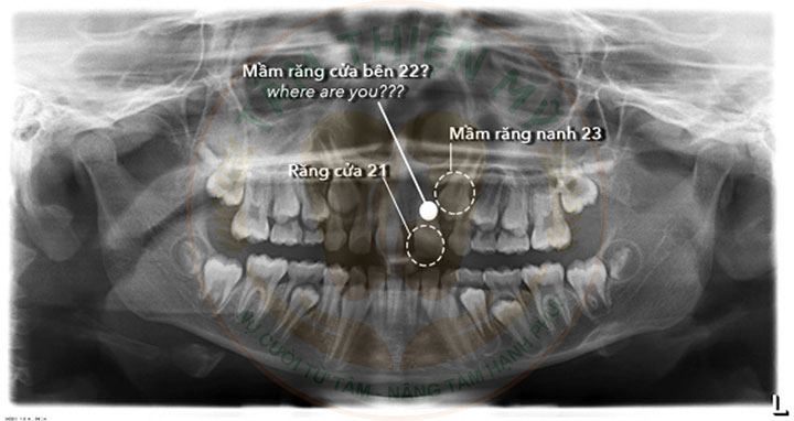 Dấu hiệu trẻ bị thiếu răng bẩm sinh là gì? Nguyên nhân và cách xử 8 trẻ thiếu răng bẩm sinh