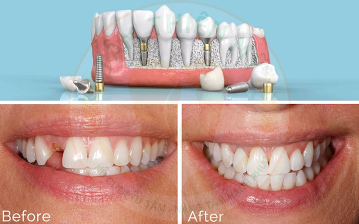 Mầm răng vĩnh viễn là gì? Không có mầm răng vĩnh viễn phải làm sao? 7 Không có mầm răng vĩnh viễn