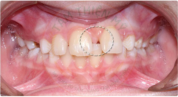 Dấu hiệu trẻ bị thiếu răng bẩm sinh là gì? Nguyên nhân và cách xử 2 Thiếu răng bẩm sinh