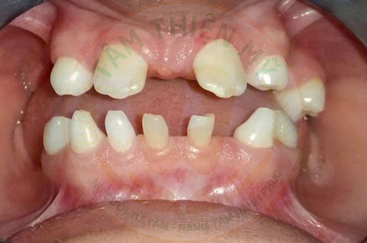 Dấu hiệu trẻ bị thiếu răng bẩm sinh là gì? Nguyên nhân và cách xử 1 Thiếu răng bẩm sinh