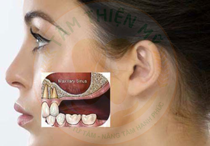 tiêu xương do mất răng 7 lâu năm