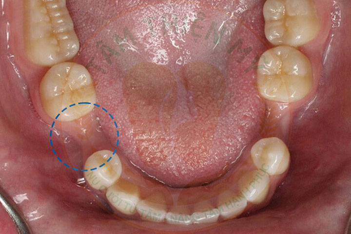 Mất răng 5 bị tiêu xương hàm có cắm được Implant không? 6 Mất răng 5 bị tiêu xương hàm