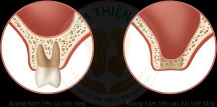 Làm cầu răng sứ có bị tiêu xương không