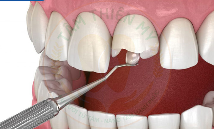 trám răng điều trị nứt gãy chân răng