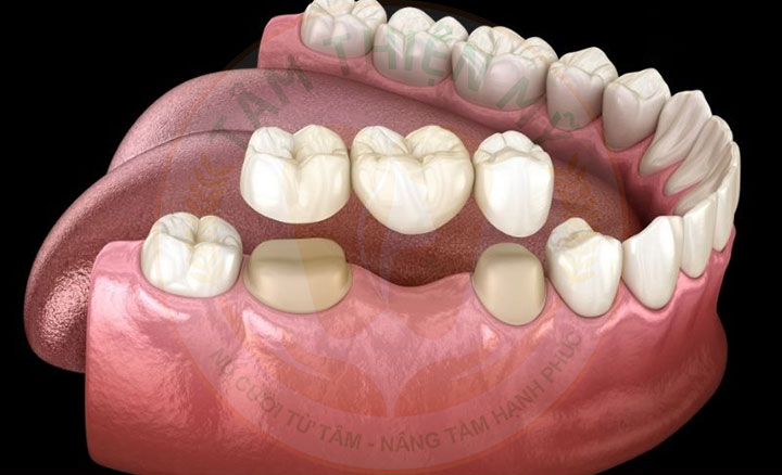 phục hình răng số 6 bằng cầu răng