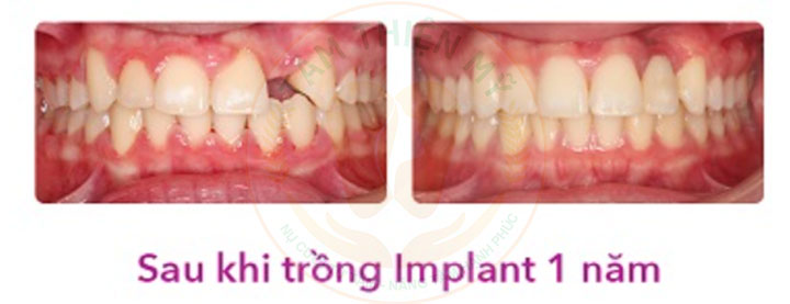 Dấu hiệu trẻ bị thiếu răng bẩm sinh là gì? Nguyên nhân và cách xử 7 trồng implant cho trẻ thiếu răng bẩm sinh