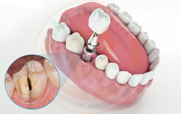 trồng implant điều trị nứt gãy chân răng