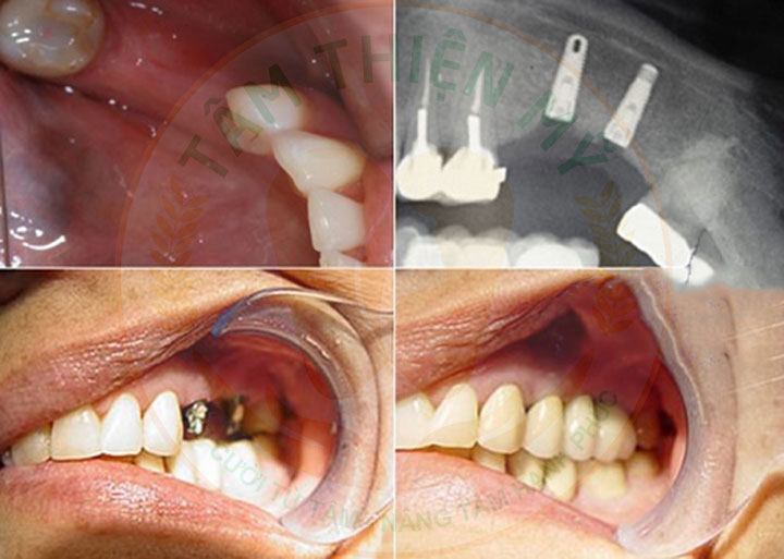 Trồng răng Implant phục hình răng số 7 hàm trên bị mất