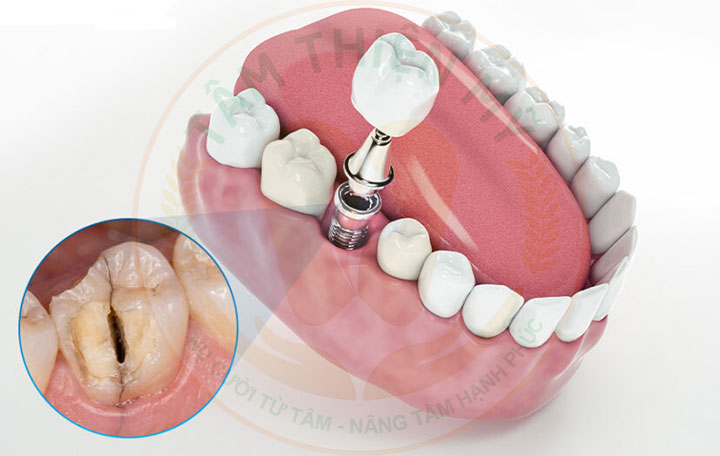 trồng implant điều trị nứt gãy chân răng