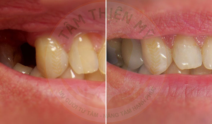 Nguyên nhân và hậu quả khi mất răng số 5- Phục hình răng 5 hiệu 5 Cấy ghép Implant phục hình răng 5