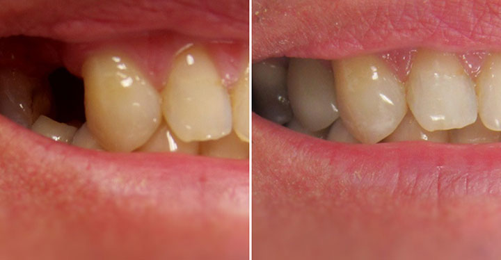 Mất răng 5 bị tiêu xương hàm có cắm được Implant không? 8 Mất răng 5 bị tiêu xương hàm có cắm được Implant không