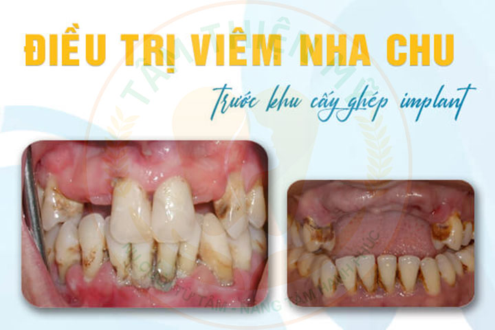 viêm nha chu có trồng răng Implant được không