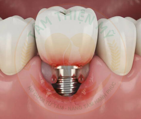 Viêm xoang có trồng Implant được không