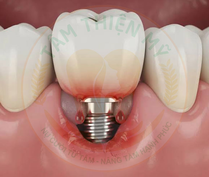 Viêm xoang có trồng Implant được không