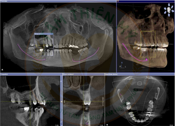 Viêm xoang có trồng Implant được không