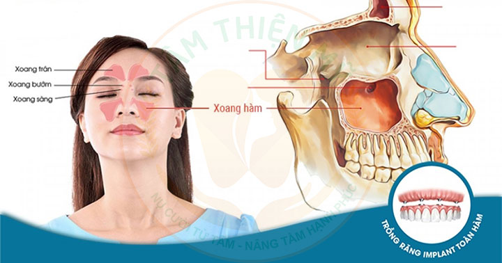 Bị viêm xoang có cấy Implant toàn hàm được không