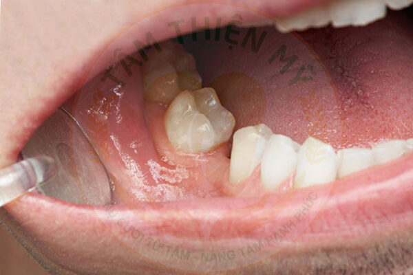 hậu quả thiếu mầm răng 5 vĩnh viễn
